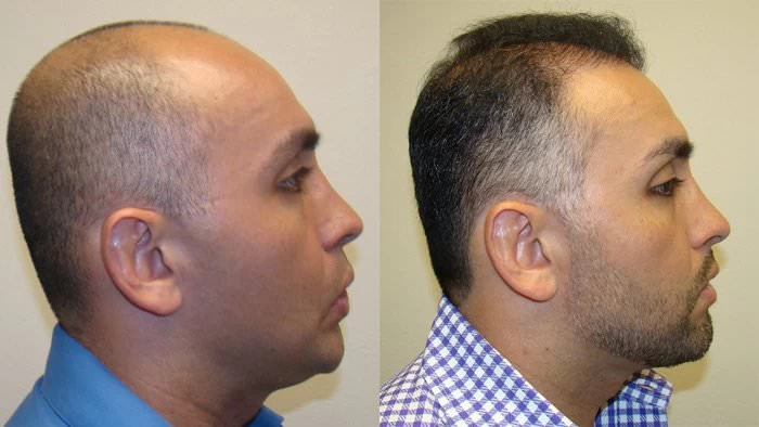 Patient p109 hair transplant before and after right view