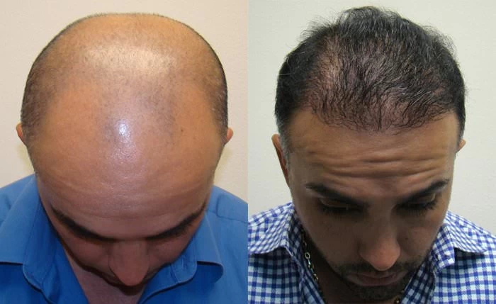 Patient p109 hair transplant before and after tilt view