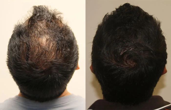 Patient p111 hair transplant before and after crown view