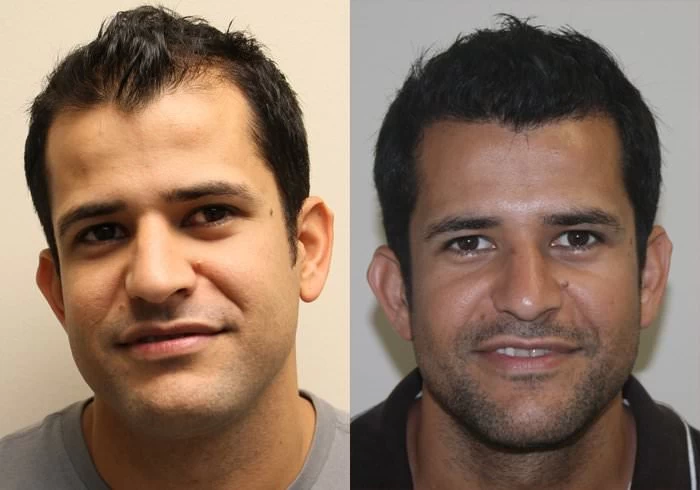 Reynato Hair Transplant Before and After