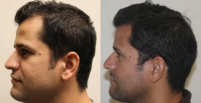 Patient p111 hair transplant before and after left view
