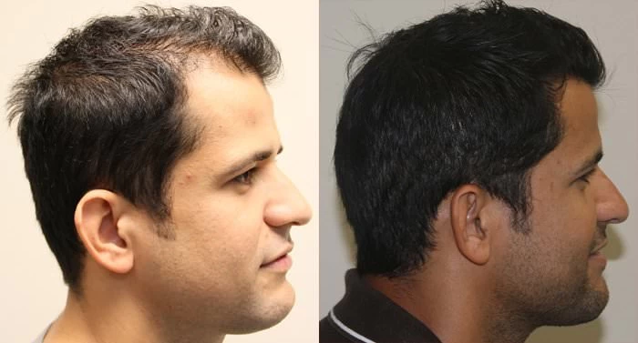 Patient p111 hair transplant before and after right view