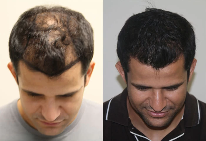 Patient p111 hair transplant before and after tilt view