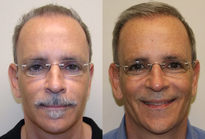 Mike Hair Transplant Before and After