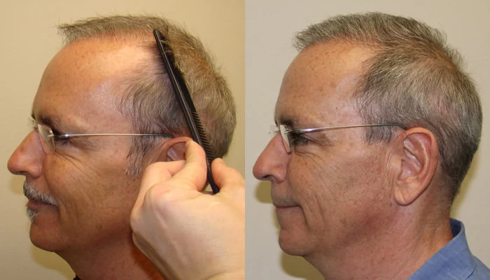 Patient p112 hair transplant before and after left view