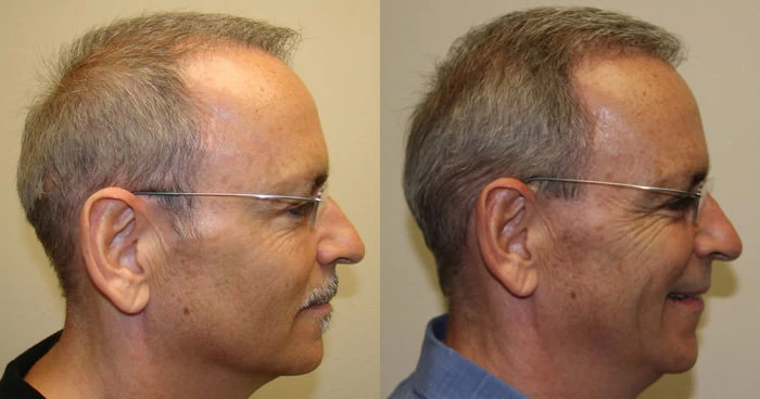Patient p112 hair transplant before and after right view