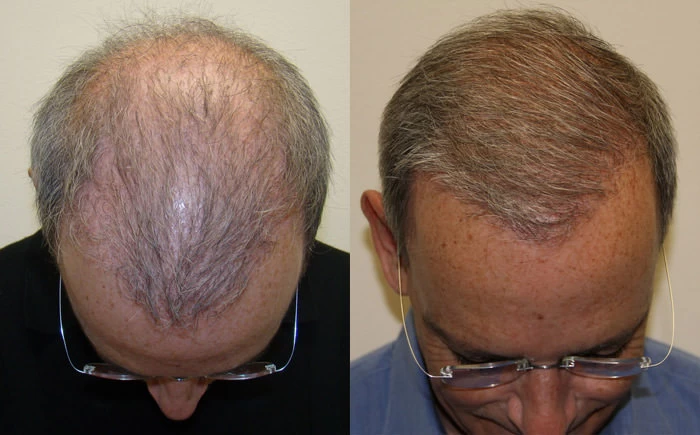 Patient p112 hair transplant before and after tilt view