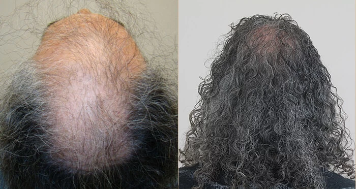 Patient p115 hair transplant before and after crown view