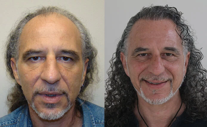 Menotti Hair Transplant Before and After