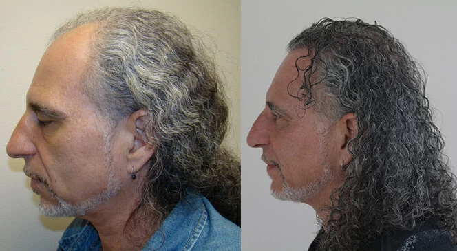 Patient p115 hair transplant before and after left view