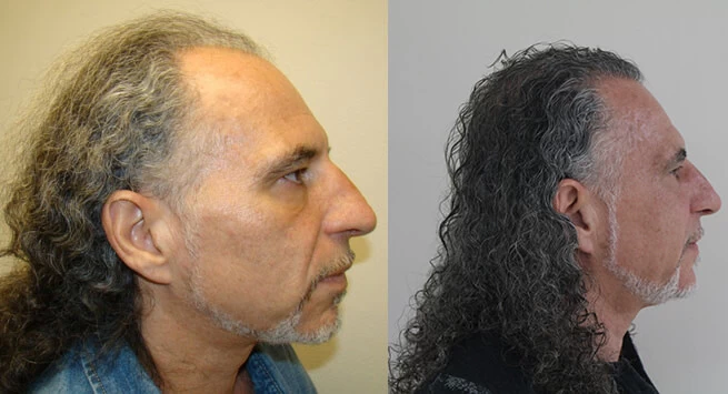 Patient p115 hair transplant before and after right view