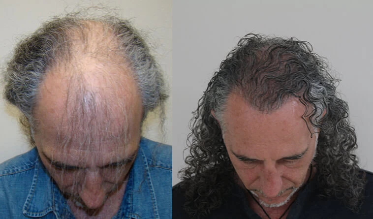 Patient p115 hair transplant before and after tilt view