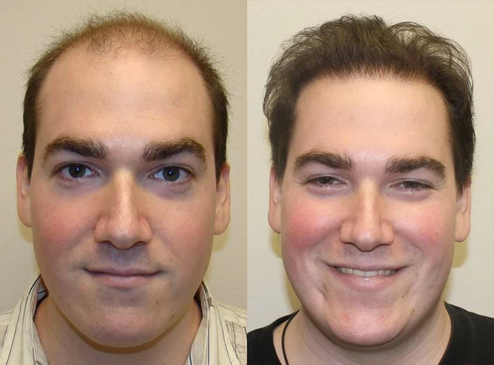 Tom Hair Transplant Before and After
