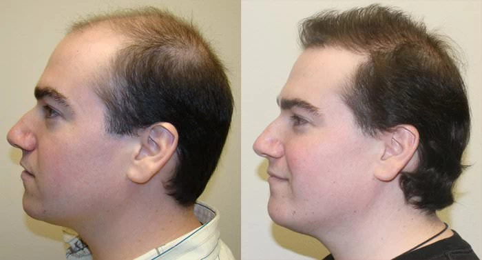 Patient p116 hair transplant before and after left view