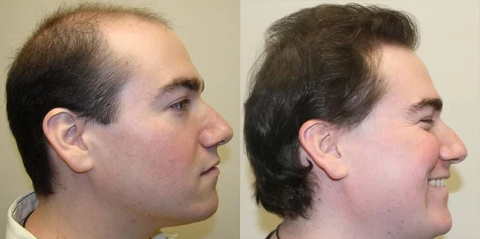 Patient p116 hair transplant before and after right view
