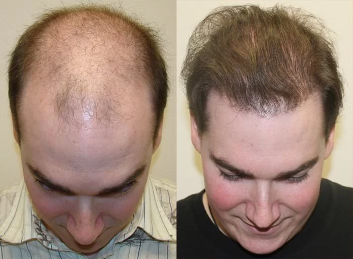 Patient p116 hair transplant before and after tilt view