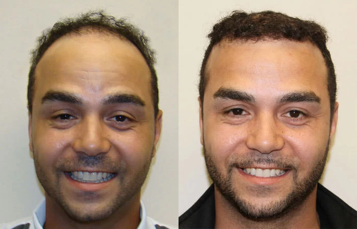 Corey Hair Transplant Before and After