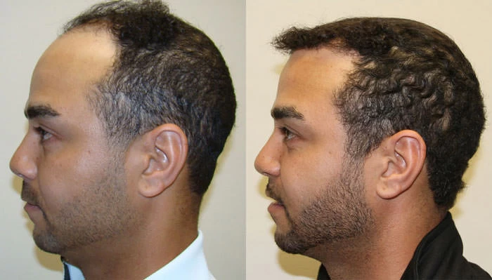 Patient p117 hair transplant before and after left view