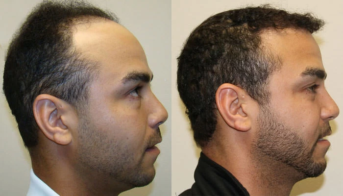 Patient p117 hair transplant before and after right view