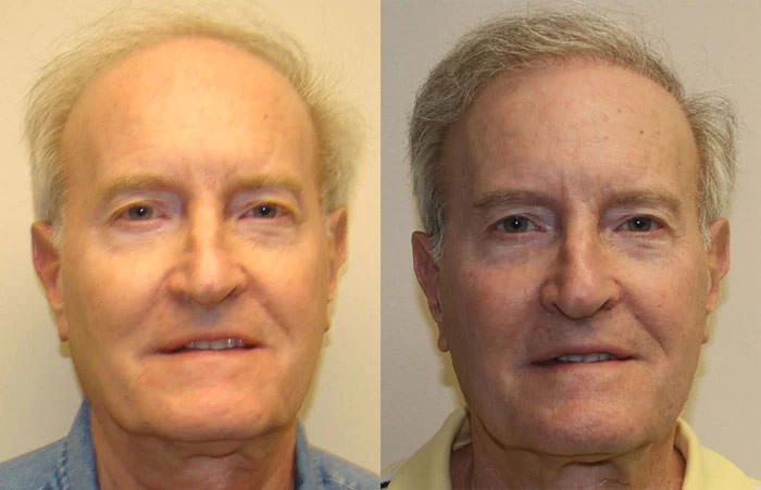 Jerry Hair Transplant Before and After