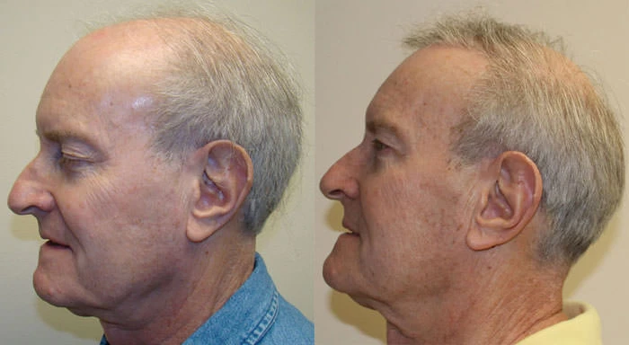 Patient p118 hair transplant before and after left view