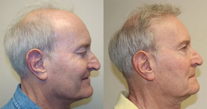 Patient p118 hair transplant before and after right view