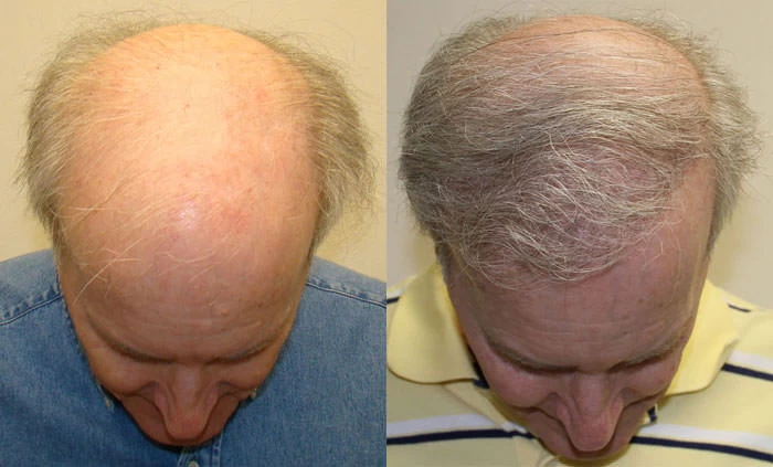 Patient p118 hair transplant before and after tilt view