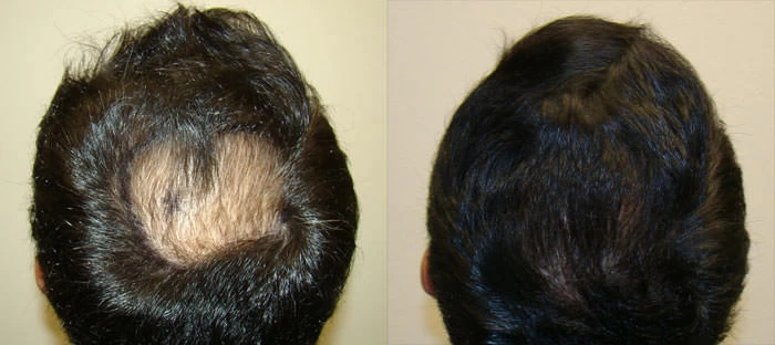 Patient p11 hair transplant before and after crown view