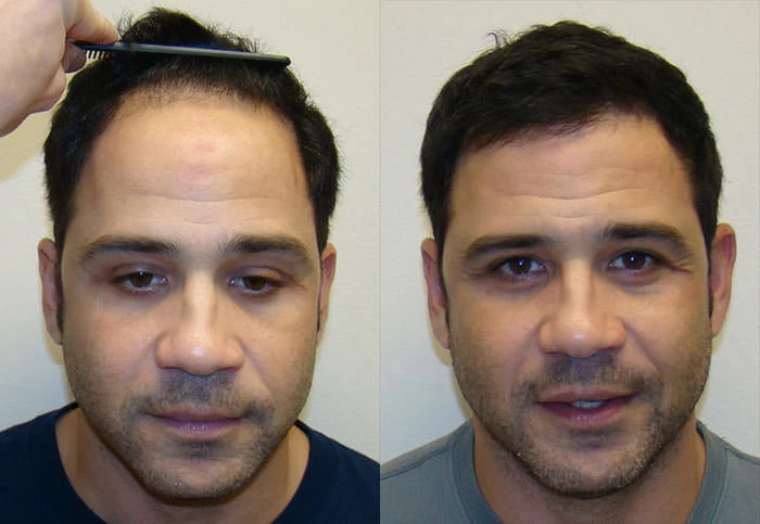 Jaime Hair Transplant Before and After