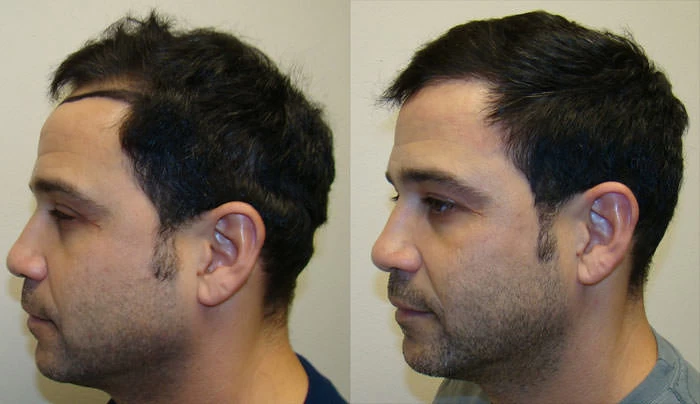 Patient p11 hair transplant before and after left view