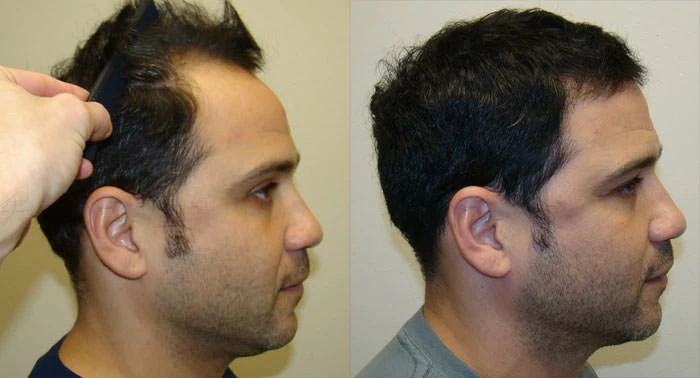 Patient p11 hair transplant before and after right view