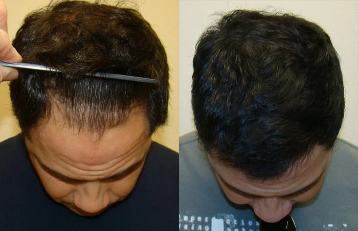 Patient p11 hair transplant before and after tilt view