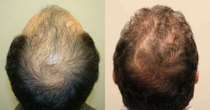 Patient p121 hair transplant before and after crown view