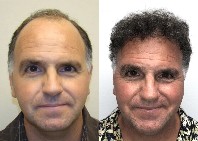 Patient 121 Hair Transplant Before and After
