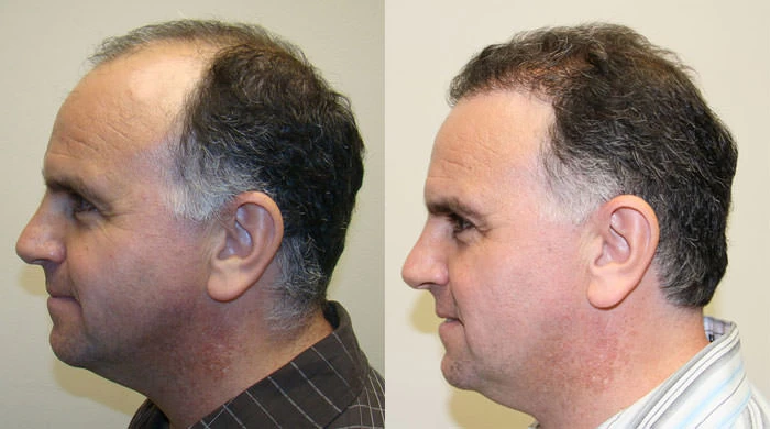Patient p121 hair transplant before and after left view