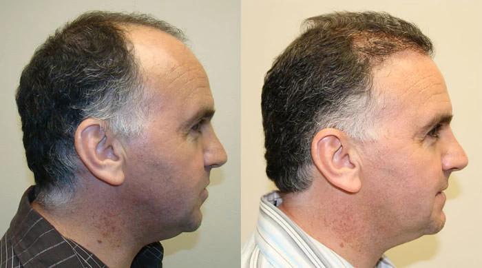 Patient p121 hair transplant before and after right view