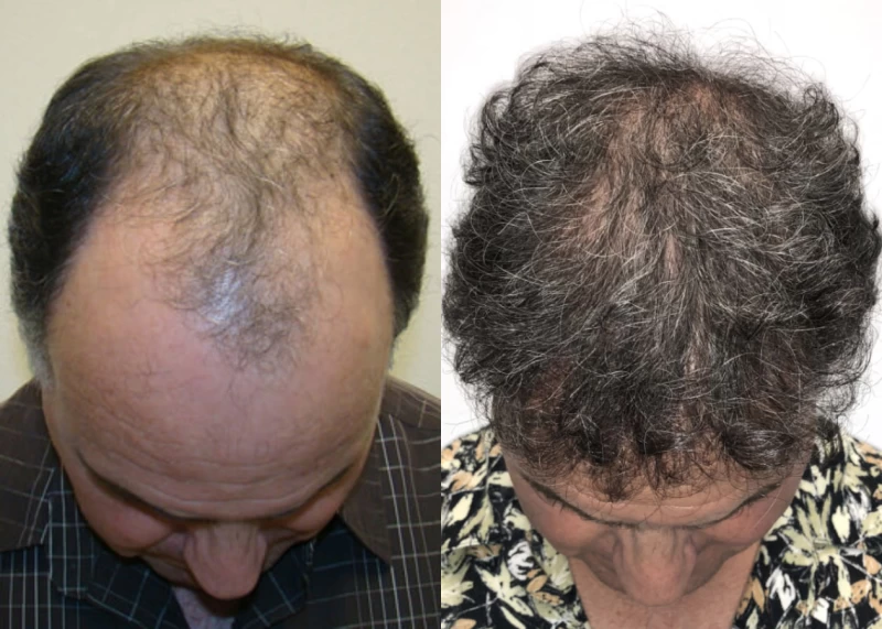 Patient p121 hair transplant before and after tilt view
