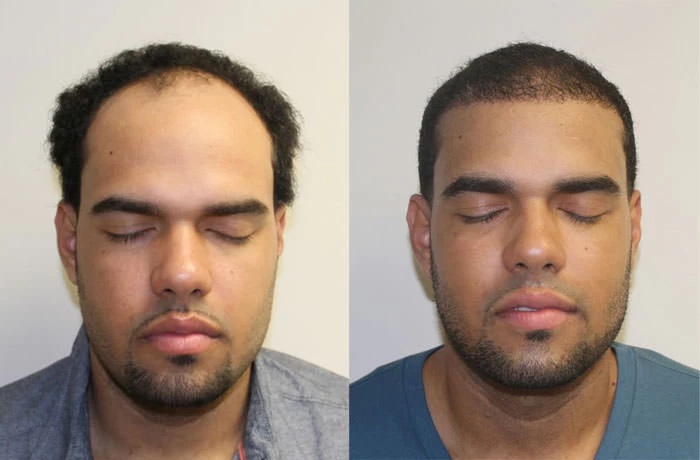 Nestor Hair Transplant Before and After
