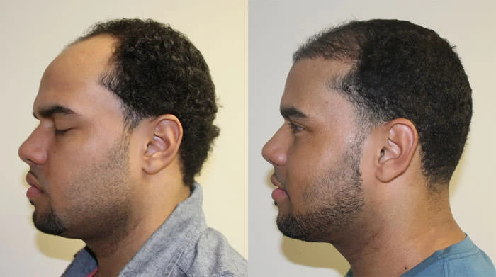 Patient p122 hair transplant before and after left view