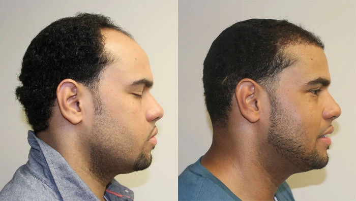 Patient p122 hair transplant before and after right view