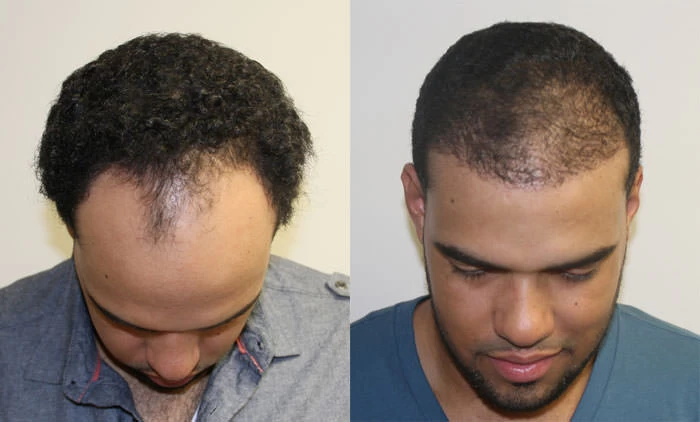 Patient p122 hair transplant before and after tilt view