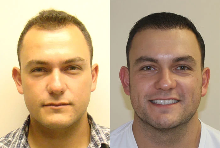 Juan Hair Transplant Before and After