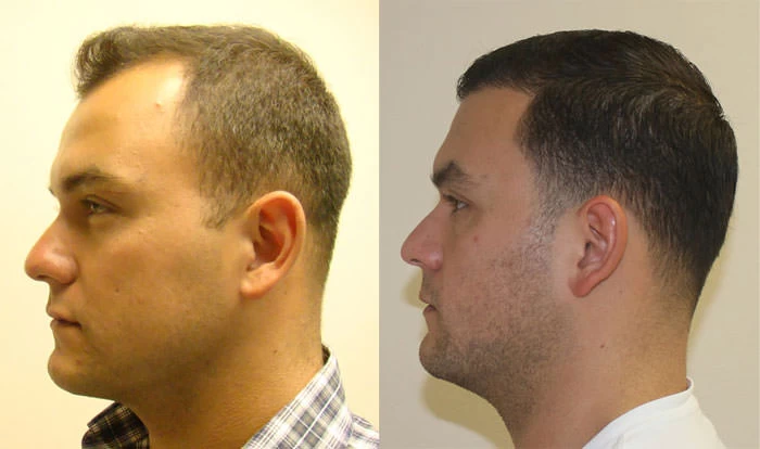 Patient p123 hair transplant before and after left view