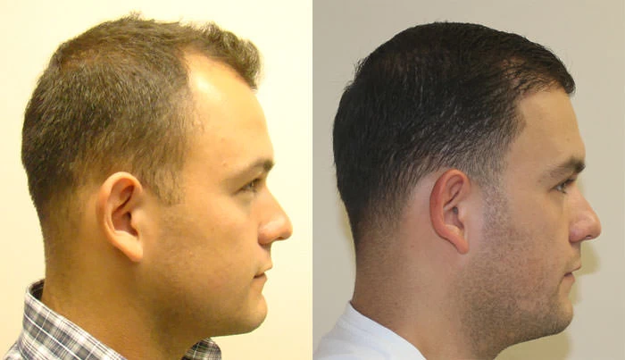 Patient p123 hair transplant before and after right view
