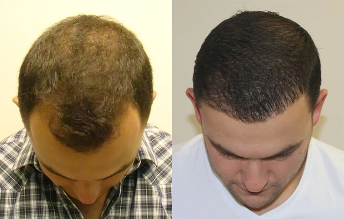 Patient p123 hair transplant before and after tilt view