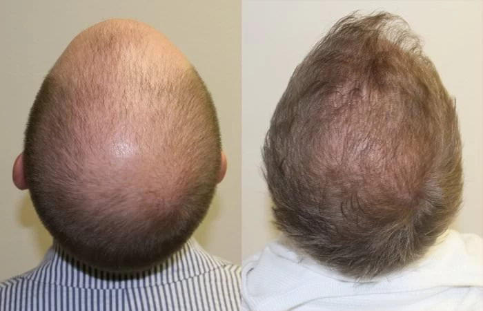 Patient p127 hair transplant before and after crown view