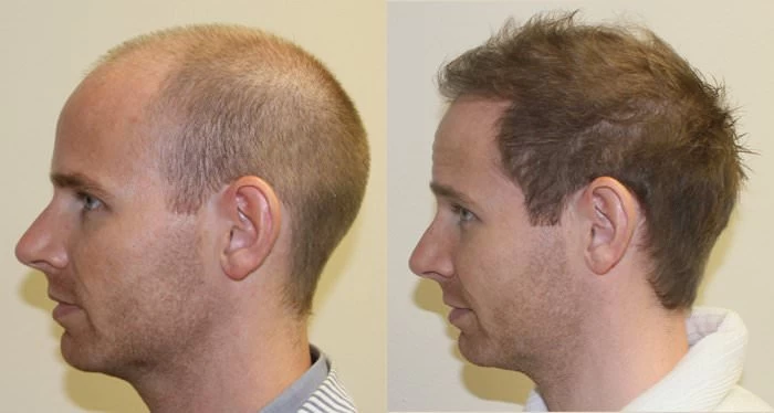 Patient p127 hair transplant before and after left view
