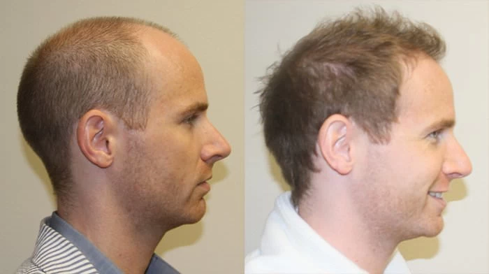 Patient p127 hair transplant before and after right view