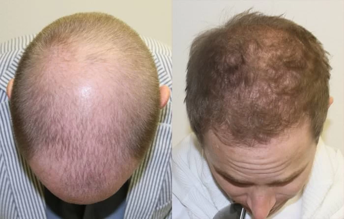 Patient p127 hair transplant before and after tilt view