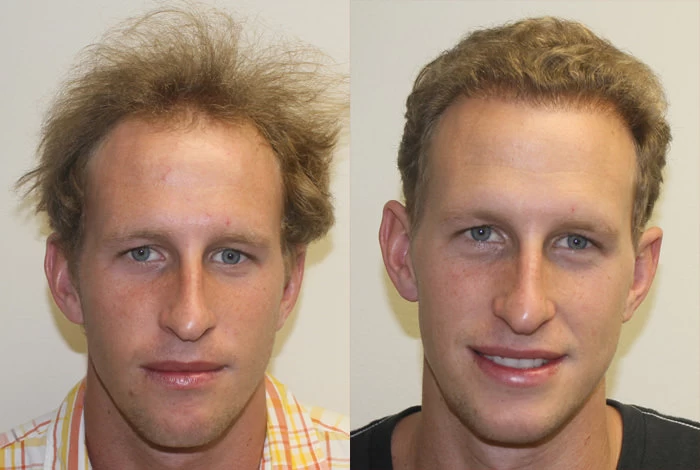 Cameron Hair Transplant Before and After